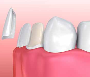 covington ga dentist offers lab fabricated porcelain veneers as a treatment option for imperfect teeth 5f512a4eb9a6b