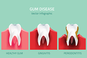 periodontics img2