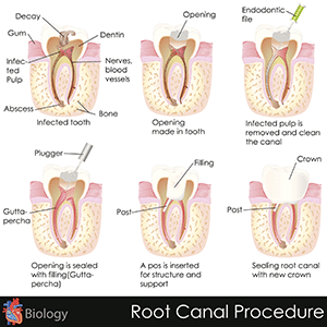 root canals img1