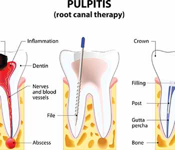 so you are having a root canal procedure then what 5f512b0a544e3